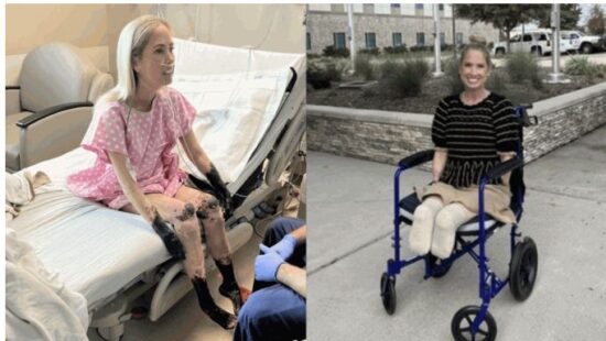 和平日报 | 發高燒以為小感冒 女老師四肢發黑壞死須截肢 一原因令病情急轉直下